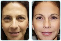 Restore a Youthful Look with a Mini Face Lift in The Woodlands