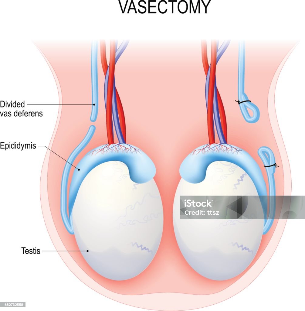 Recovery and Aftercare Tips for Vasectomy Patients in NZ
