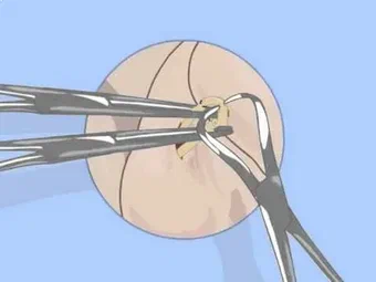 Recovery After Vasectomy in Auckland: Tips for a Smooth Healing Process