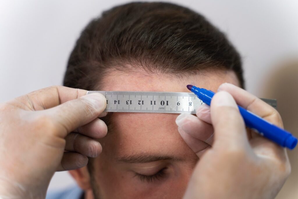 The Secret to Natural-Looking Hair Transplants: Tips from Experts